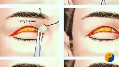 Blefaroplastia deixa paciente com cicatrizes e sequelas nos olhos