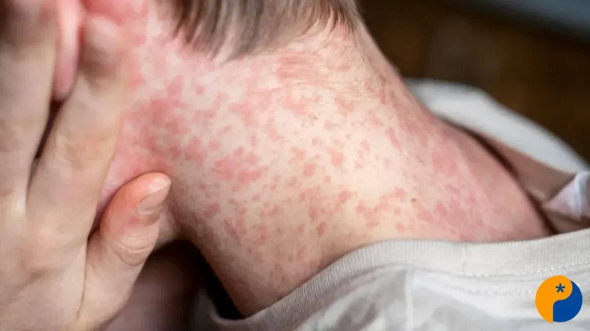 Sarampo: entenda os principais sintomas, riscos e como se proteger da doença contagiosa