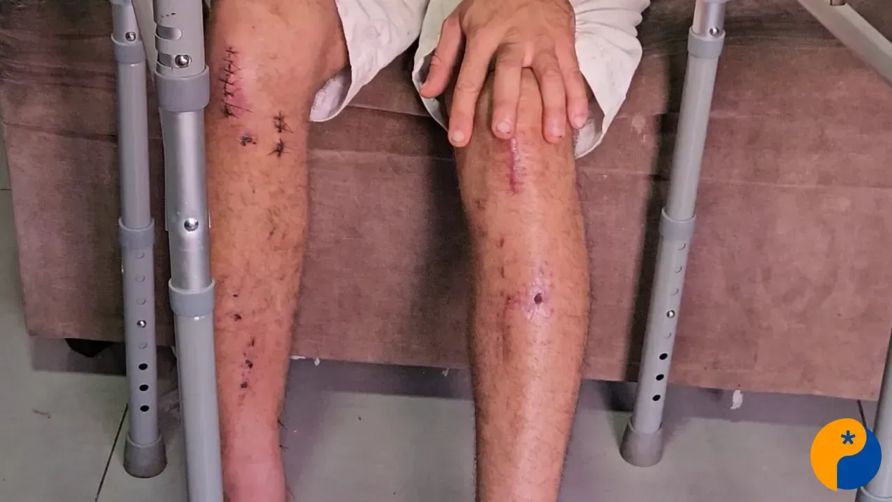 Motoboy sofre dois acidentes em menos de dois meses e precisa de ajuda em Patos de Minas 