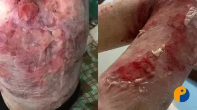 Aos 28 anos, mulher convive com doença rara que provoca feridas e dores pelo corpo